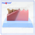 PNT-0528ad educational Osteoporosis Diseased Dental Teeth Model